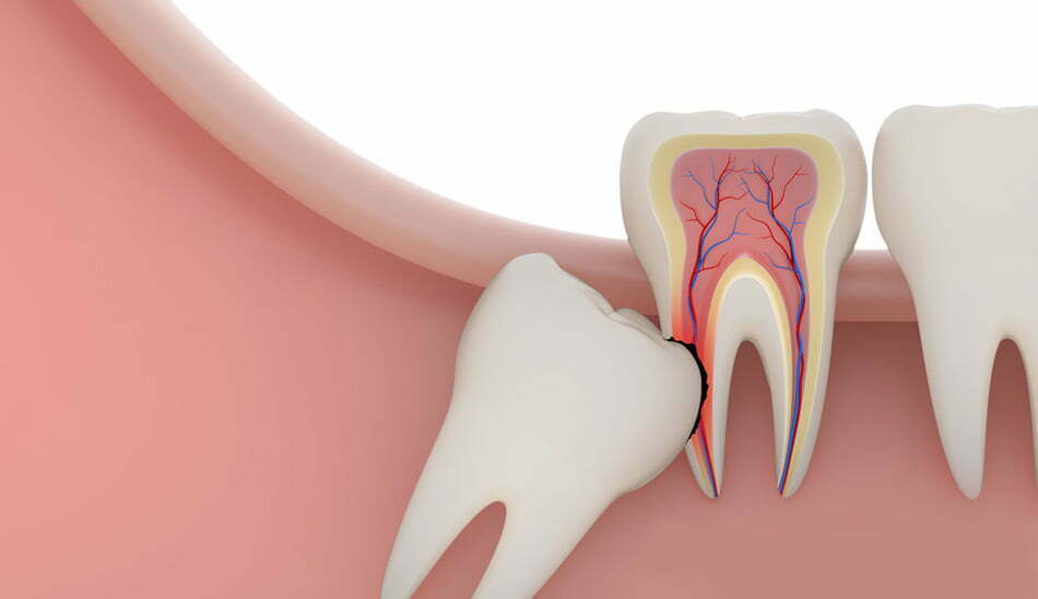 دندان عقل/wisdom tooth