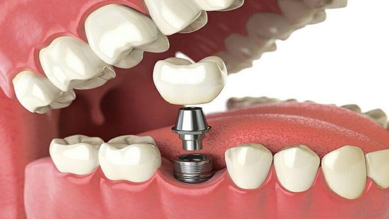 تجهیزات پزشکی ایمپلنت دندان
