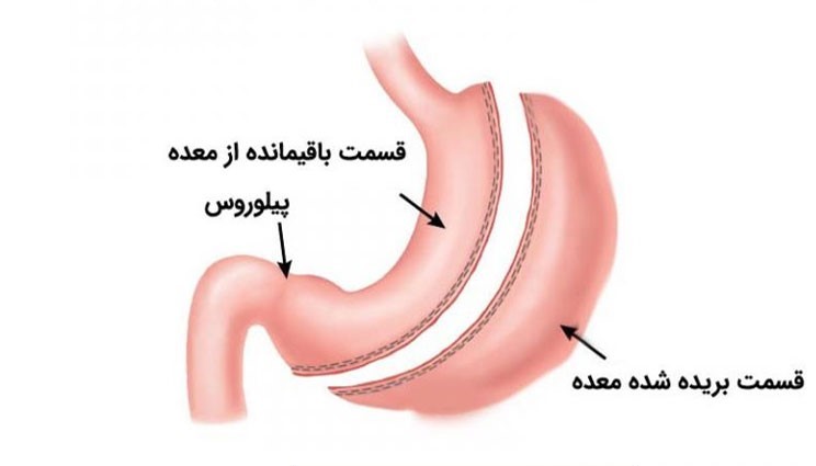 عمل اسلیو بهتر است یا بای پس؟