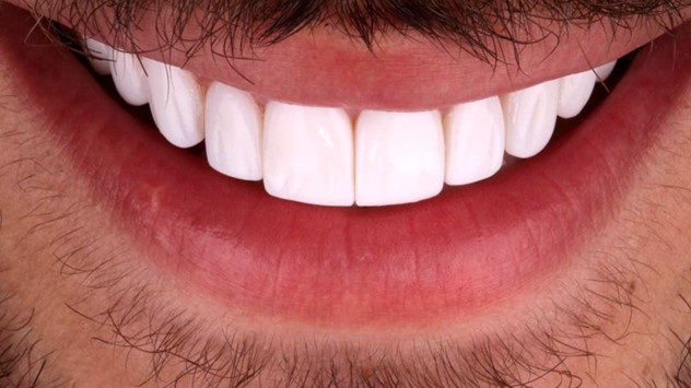 کامپوزیت یا لمینت دندان، کدام بهتر است؟