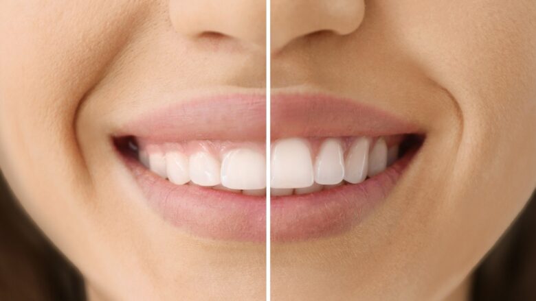 cosmetic-gum-surgery
